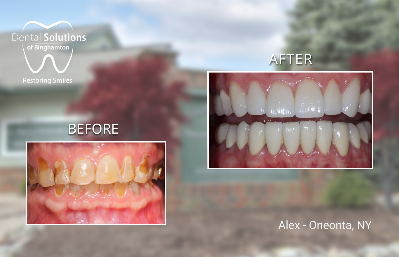 Dental Crowns Binghamton, NY