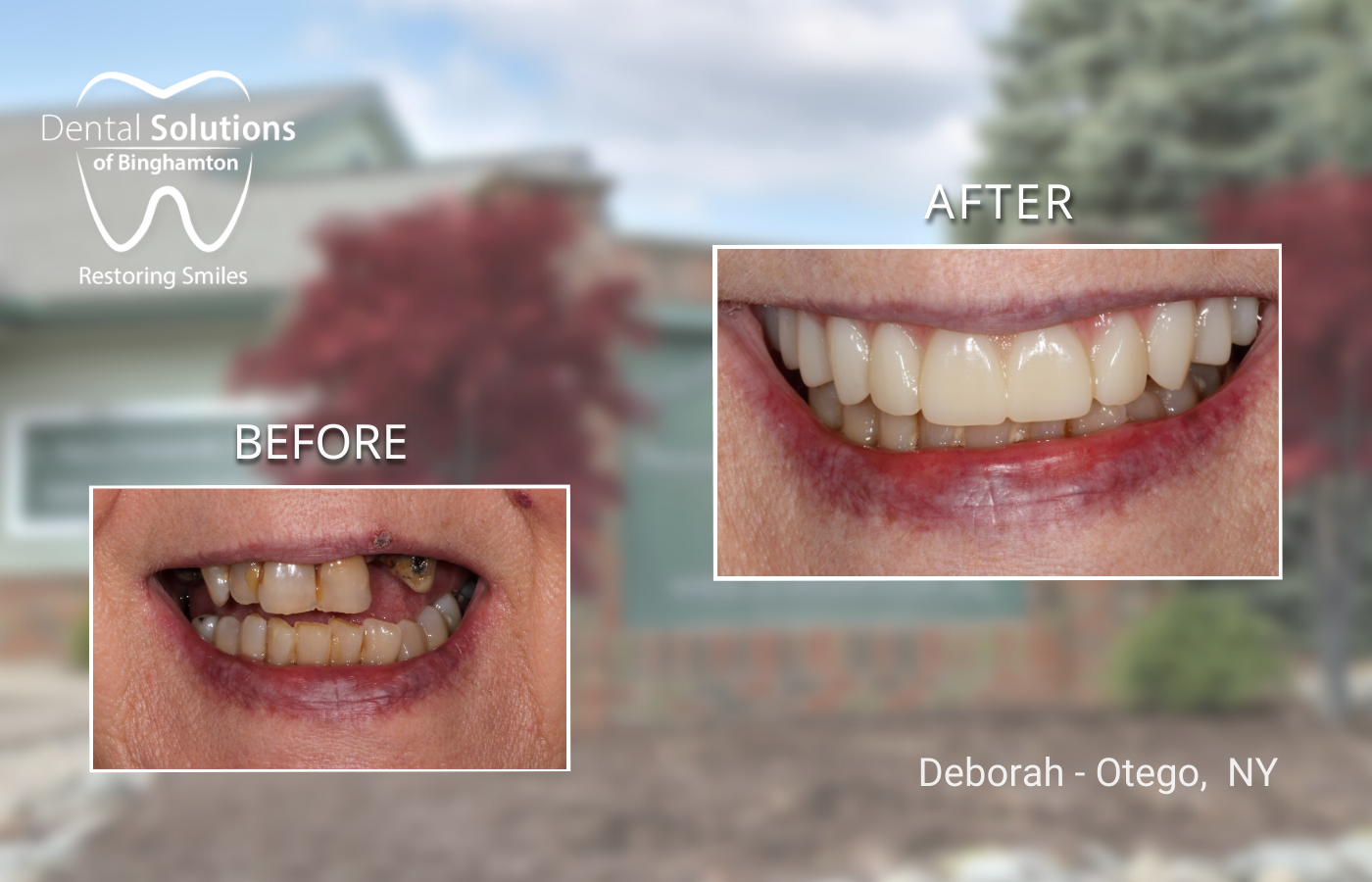 Dental Implants Binghamton, NY