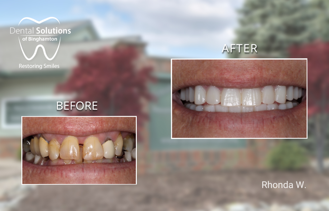 Hybridge Dental Implants